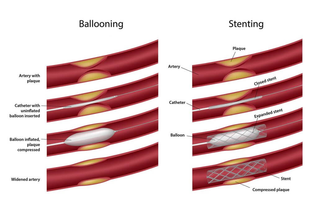 Ballooning-Stenting