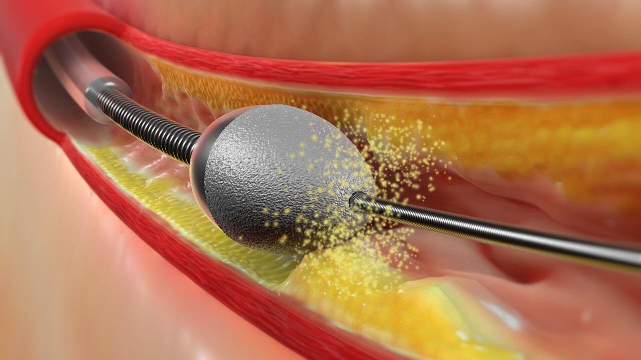 Rotablation Angioplasty Procedure