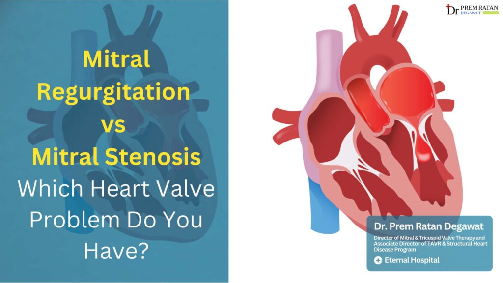 Mitral Regurgitation vs Mitral Stenosis