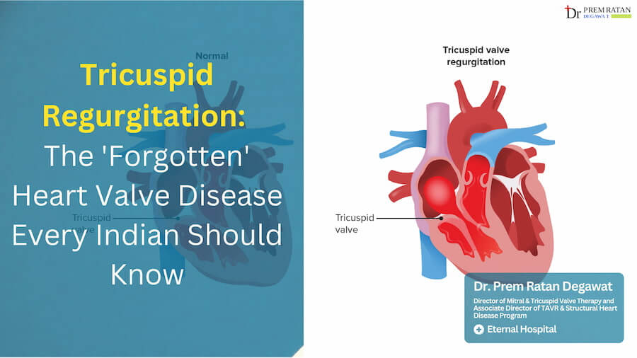 Tricuspid Regurgitation
