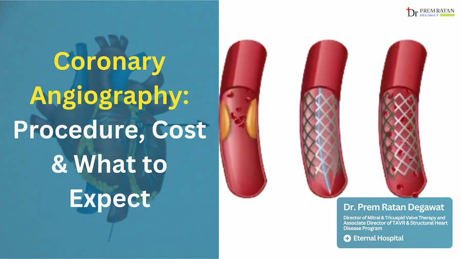 Coronary Angiography