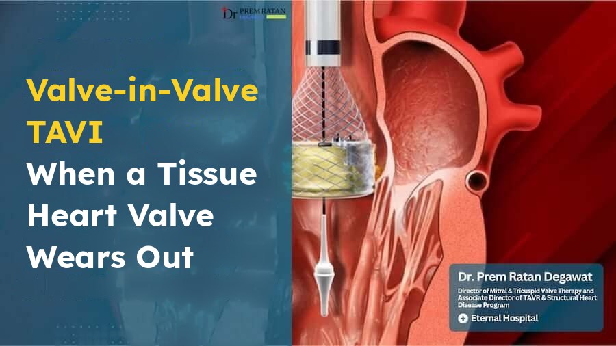 Valve-in-valve TAVI for a worn tissue heart valve, with an illustration of catheter-based aortic valve replacement.